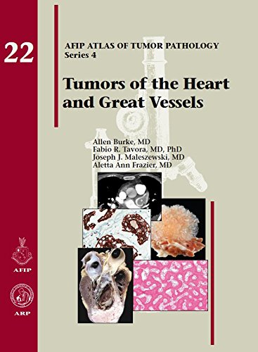 Tumors Of The Heart And Great Vessels