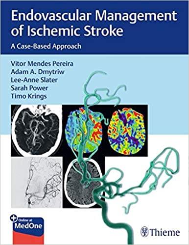 Endovascular Management Of Ischemic Stroke