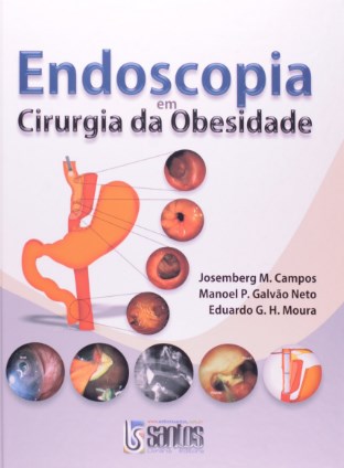 Endoscopia Em Cirurgia Da Obesidade