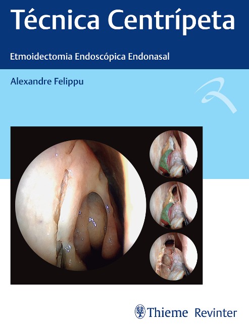 Técnica Centrípeta: Etmoidectomia Endoscópica Endonasal